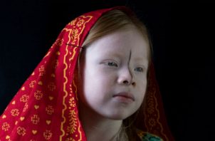 Evaluarán cumplimiento de los derechos de las persona albinas en Panamá. Foto: Archivos