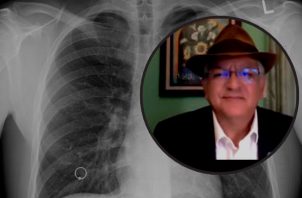 Doctor Alberto Colorado, integrante de la Coalición de TB de las Américas. Foto: Cortesía