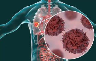 El tabaquismo es responsable de entre el 80 y 90% de los casos de cáncer de pulmón en el país.