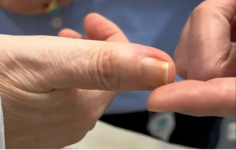 Una simple manicura casi le cuesta el dedo a una panameña tras sufrir una infección en el hueso del pulgar
