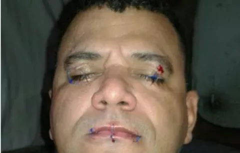 Privado de libertad se cose la boca y los ojos como medida de protesta