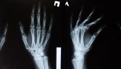 Osteoporosis: Claves para prevenir esta patología