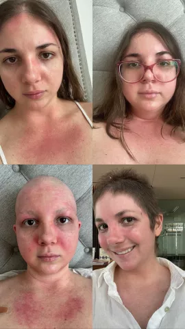 Cáncer: la actitud y la red de apoyo importan