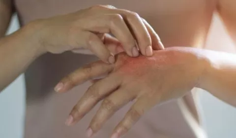 Psoriasis en Panamá: 80 mil personas padecen de esta enfermedad