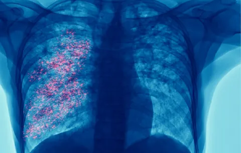 Cáncer de pulmón encabeza las muertes por tumores; especialistas urgen frenar el diagnóstico tardío