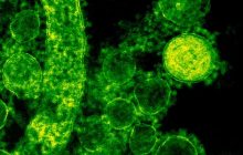 Bacteria Come carne es una infección en la sangre produce lesiones en la piel con ampollas, además de fiebre, escalofríos y presión baja. Foto: ilustrativa