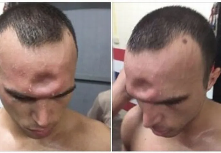 Así quedó la cabeza de Jeremy tras el golpe. Foto Facebook Jonny Betts