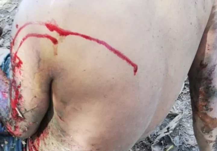 El joven perdió varias partes de sus extremidades de pies, mano, mantenía una herida profunda en el abdomen y el cuerpo presentaba un 80% de quemaduras.
