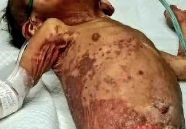 El menor murió por una falla a multiorgánica por las infecciones severas que tenia en la piel. Foto: Mayra Madrid.