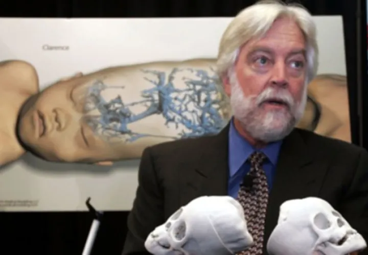 Dr. James T. Goodrich, destacado neurocirujano que realizó dos cirugías donde separó a  gemelos unidos por el cerebro, falleció por complicaciones del coronavirus.