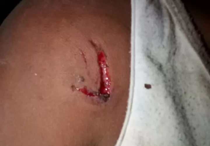 La menor fue mordida por su primo en el hombro y mano derecha. Fotos: Mayra Madrid. 