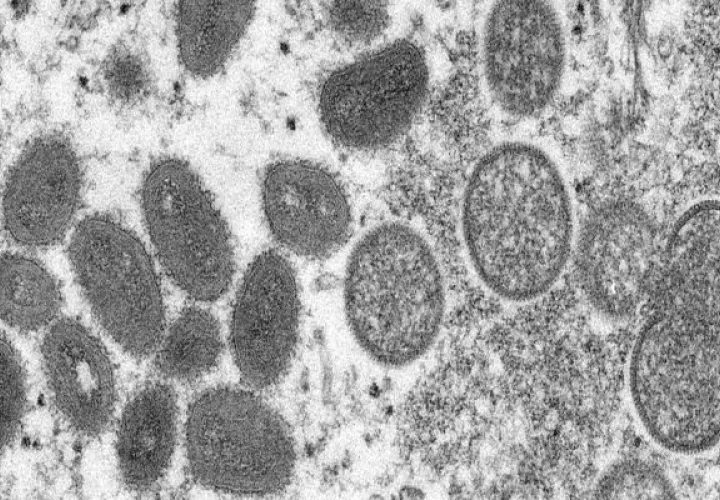 Se trata de una infección zoonótica vírica, lo que significa que puede propagarse de animales a seres humanos. También puede propagarse de persona a persona. Foto: Grupo Epasa