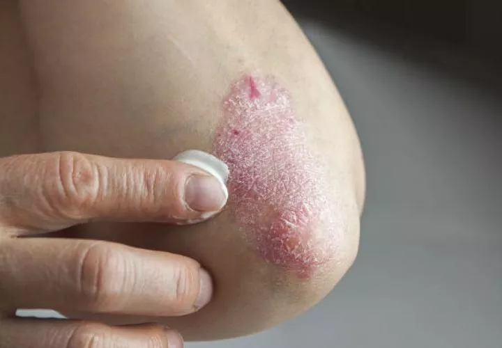 Corresponderá al Ministerio de Salud establecer un sistema de información que mantenga actualizada la lista de personas con psoriasis. Foto: Archivos