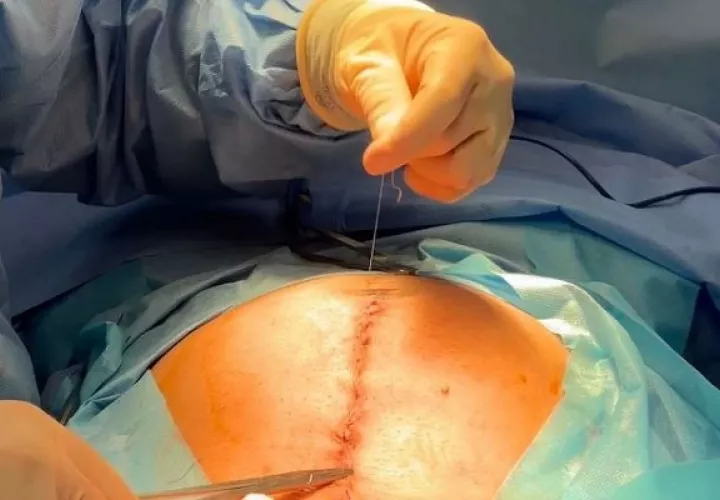 Esta operación es conocida como reparación de mielomeningocele. Foto: CSS