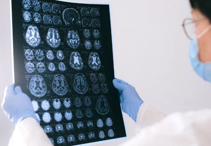 Afecta las neuronas del cerebro. Foto: Pexels