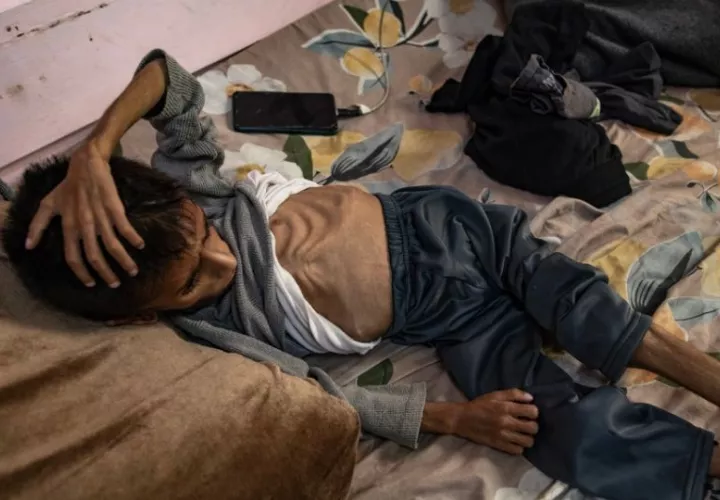 El niño palestino de cinco años Osama al-Raqab sufre de desnutrición severa. Foto: EFE