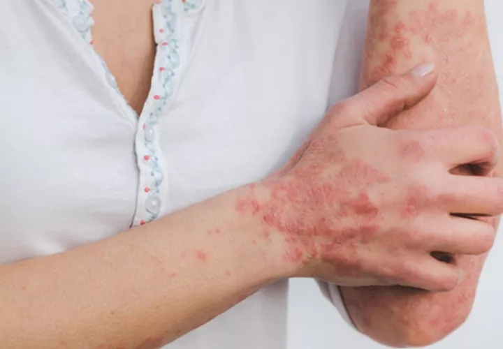 Lesiones cutáneas características de la psoriasis. Foto: Eszter Miller / Pixabay