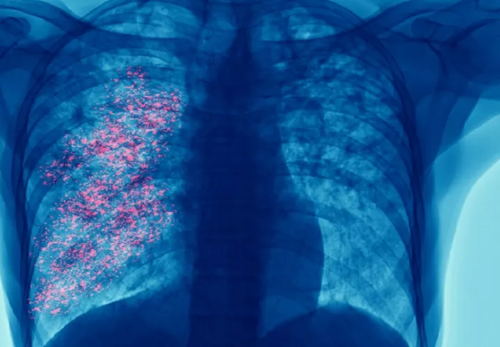 El diagnóstico tardío incrementa la carga para los pacientes, sus familias y los sistemas de salud. Cortesía/•	El diagnóstico tardío incrementa la carga para los pacientes, sus familias y los sistemas de salud. Foto: AstraZeneca