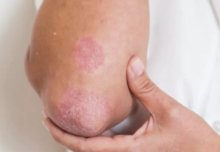Las personas que padecen psoriasis presentan lesiones escamosas en la piel. Foto Ilustrativa