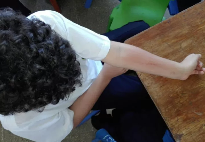 Los estudiantes del centro educativo en La Chorrera, en Panamá Oeste, presentan reacciones alérgicas en la piel. 