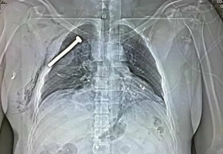 Radiografía de una de las víctimas. Foto/ EFE