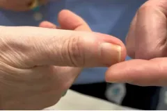 Una simple manicura casi le cuesta el dedo a una mujer tras sufrir una infección en el hueso del pulgar